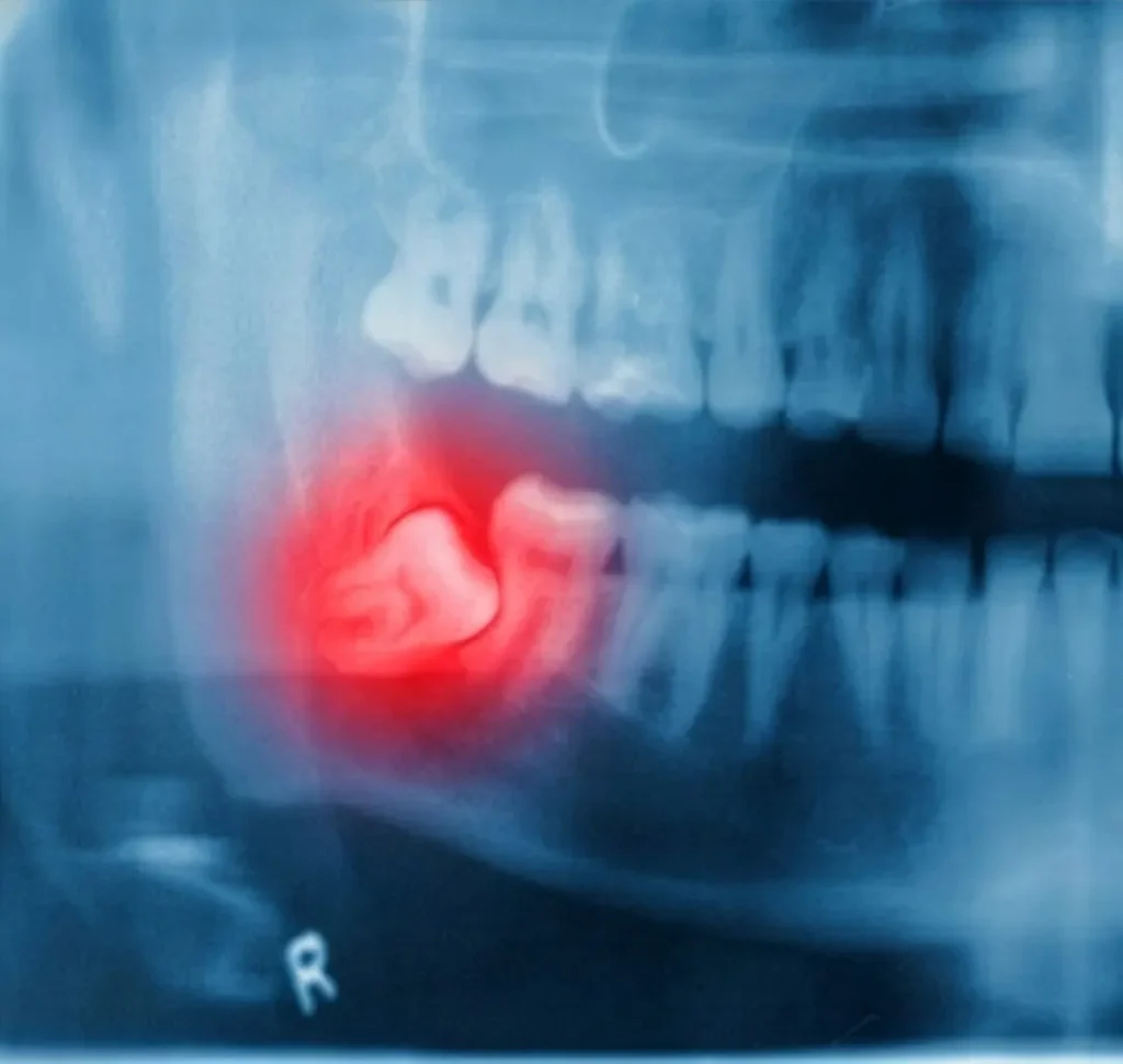 An x-ray showing the painful spot caused by an impacted wisdom tooth