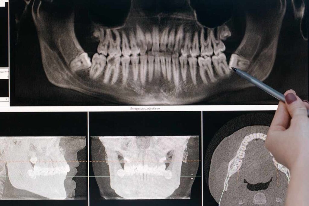 An x-ray image of impacted wisdom teeth