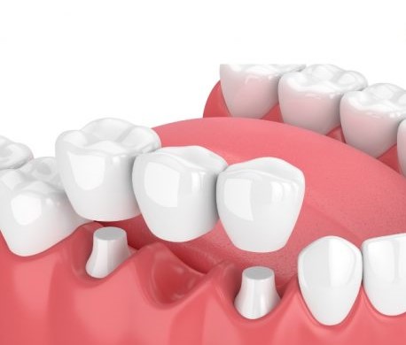 A 3d rendering of a dental bridge being placed.